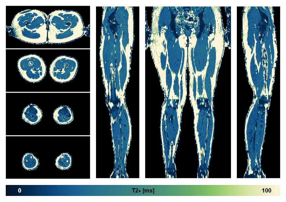 The T2 star relaxation time of the lower extremity obtained from the dixon reconstruction for muscle water fat quantification.